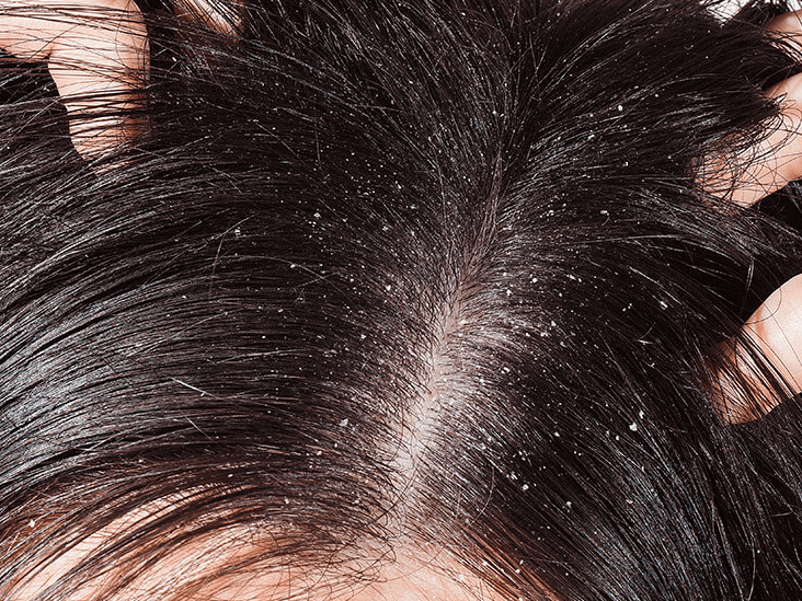 How To Get Rid Of Hair Dandruff - The Ultimate Guide! 1 Dandruff