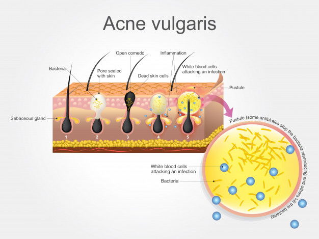 Skincare Tips For Oily Skin- The Ultimate Guide To Understand &Amp; Treat Acne! 6 Acne Vulgaris 42265 15