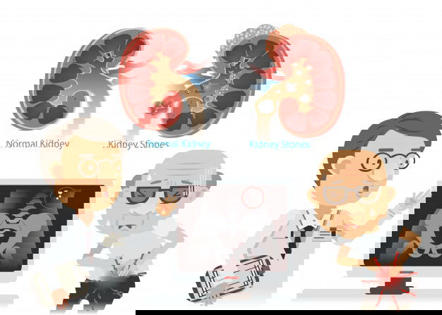 7 Foods To Get Away From Kidney Stones(Nephrolithiasis)! 2 Kidney Stones Illustration 99715 81 1