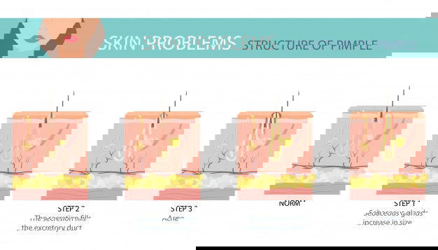 Skincare Tips For Oily Skin- The Ultimate Guide To Understand &Amp; Treat Acne! 8 Stages Acne Formation Human Skin 158677 69