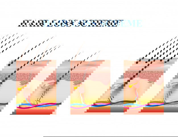 Hair Loss Scheme 1284 25923