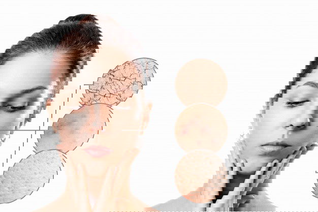 Home Remedies For Dry Skin 2 Young Woman With Acne Dry Skin Black Dots Skin Zoom Circle Young Girl Beauty Portrait Close Up 99433 684