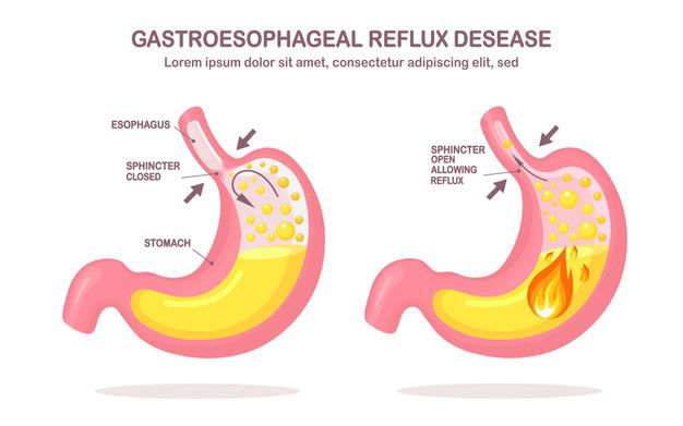 Human Stomach Gastroesophageal Reflux Disease Gerd Heartburn Gastric Infographic Acid Moving Up Into Esophagus 284092 482