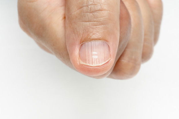 Does Your Fingernail Look Like Crescent? Do You Know What It Means? 3 White Spots Vertical Ridges Fingernails Symptoms Deficiency Vitamins Minerals 176124 377