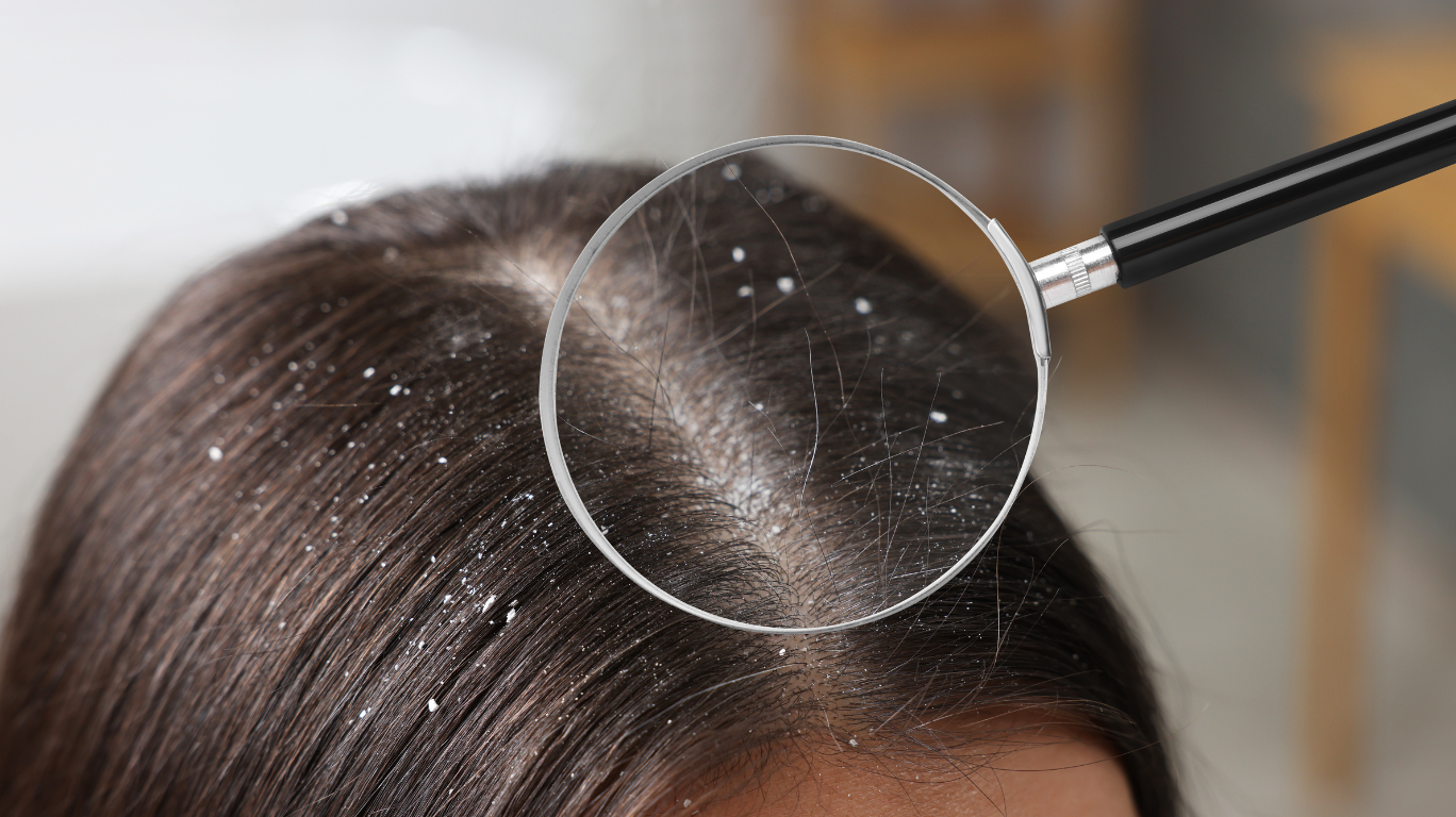 Its Anti-Inflammatory Properties Calm Irritation, Redness, And Itching Associated With Dandruff.