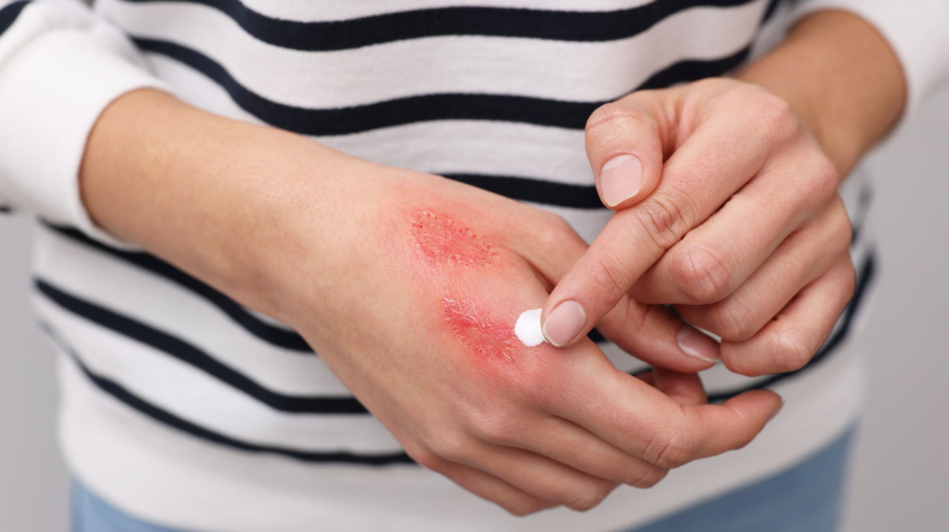 Castor Oil Promoting Wound Healing With Its Antibacterial And Moisturizing Properties