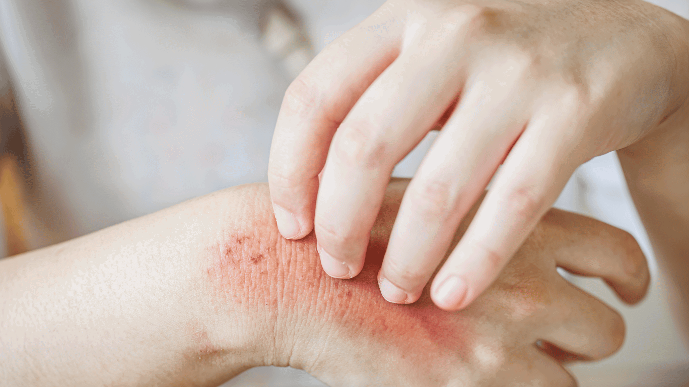 “Virgin Coconut Oil – Prevents Fungal Infections With Its Natural Antifungal Properties, Keeping Skin And Scalp Healthy!”