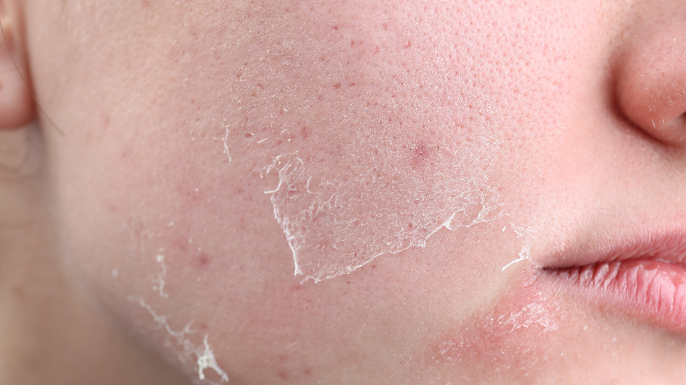 தோல் உரிதலுக்கு Cold Pressed Coconut Oil ஒரு சிறந்த இயற்கை மருந்தாகும்.
இது ஆழமான ஈரப்பதத்தை வழங்கி, உலர்ச்சி காரணமான தோல் உரிதலைத் தடுக்கும்.
அந்த பகுதியில் மெதுவாக தேய்த்தால், அழற்சி மற்றும் எரிச்சல் குறையும்.
தினமும் 2 முறை பயன்படுத்துவதால், தோல் மென்மையாகி, மீண்டும் சீராகும்.